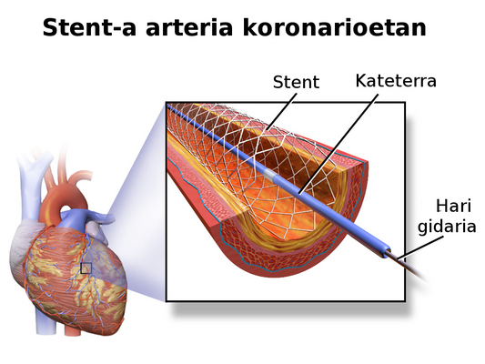 ¿Cómo se realiza una angioplastia coronaria?